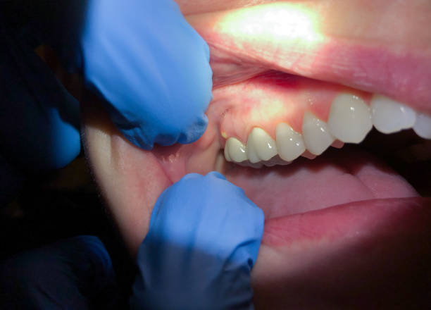 Best Emergency Wisdom Tooth Extraction in Princeton, FL